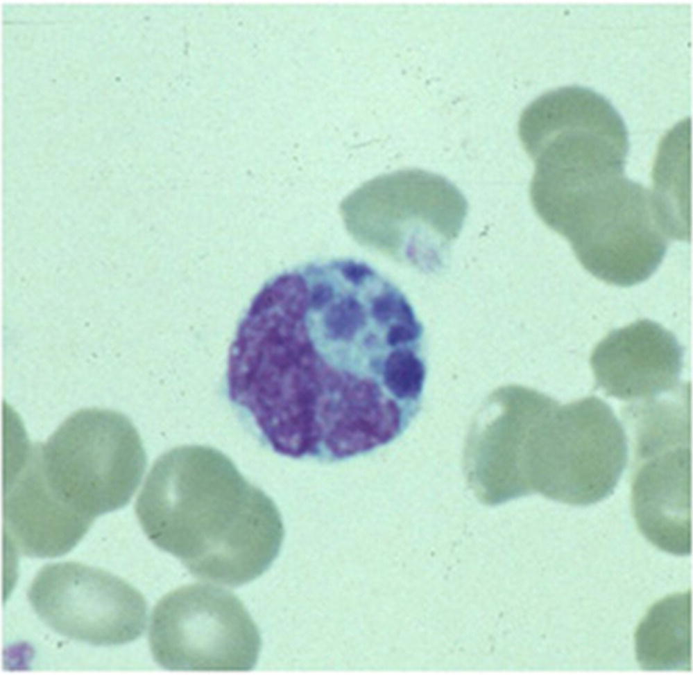 Micrograph displaying morulae in a granulocyte on a peripheral blood smear, associated with A. phagocytophilum infection.