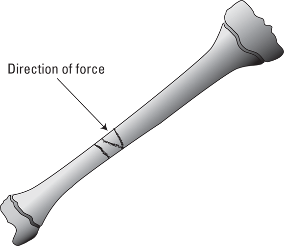 Schematic diagram depicting a bone with crush fracture and direction of force marked.