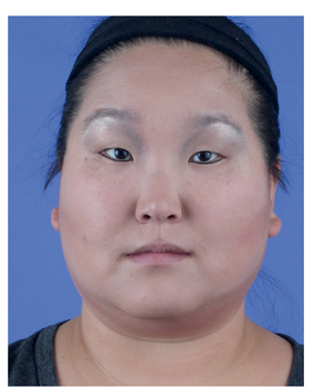 ASIAN WOMAN'S LOWER LID LINED WITH LIQUID LINER