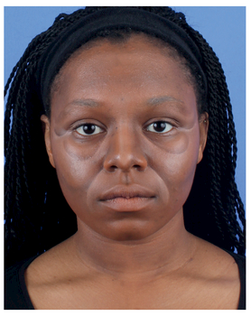 NASOLABIAL FOLDS WITH ROUNDED CHEEKS