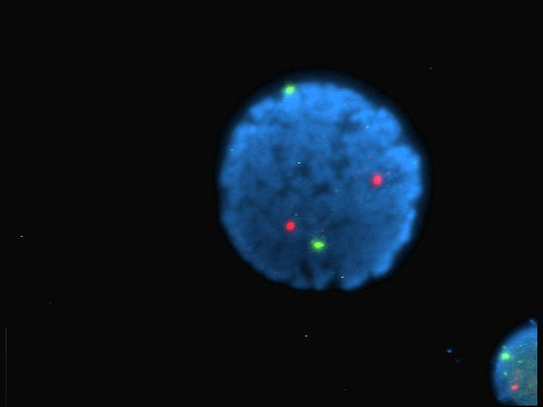 An image of a human lymphocyte nucleus with chromosomes 13 and 21 stained with DAPI (a popular fluorescent stain) to emit light.